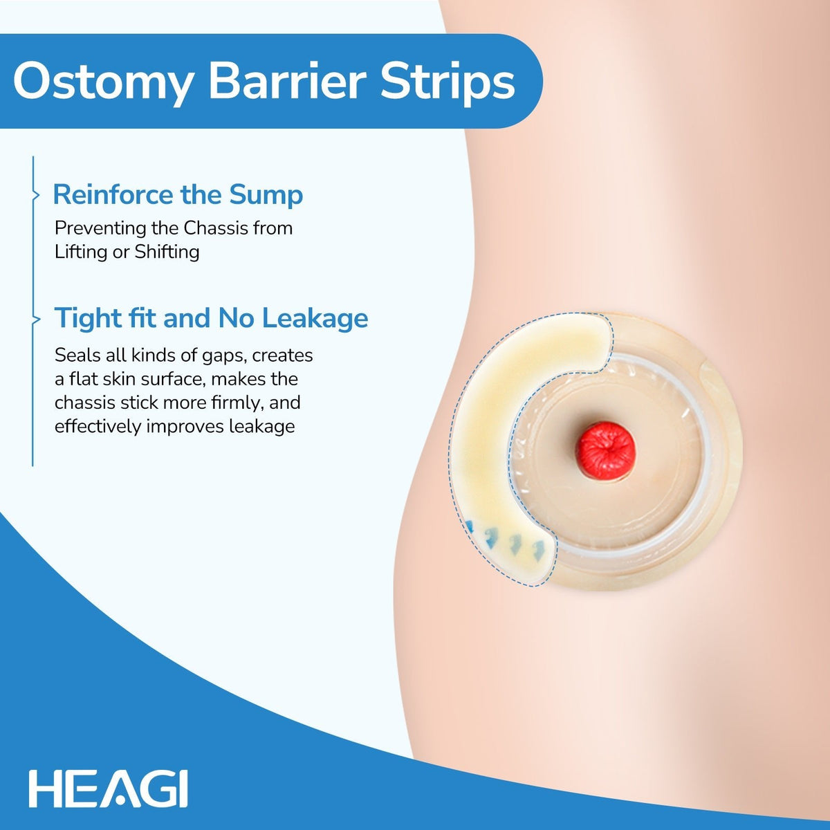 Onnohere 40PCS Elastic Barrier Strips for Ostomy Bag, Skin-Friendly Hydrocolloid Skin Barrier Strips,Osotmy Care
