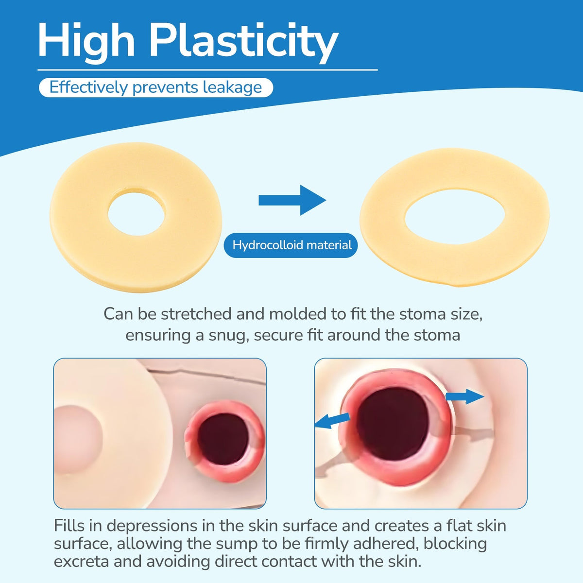 Onnohere 2mm Ostomy Barrier Rings – Hydrocolloid Moldable Seal for Leak Protection & Skin Comfort, Ostomy Care