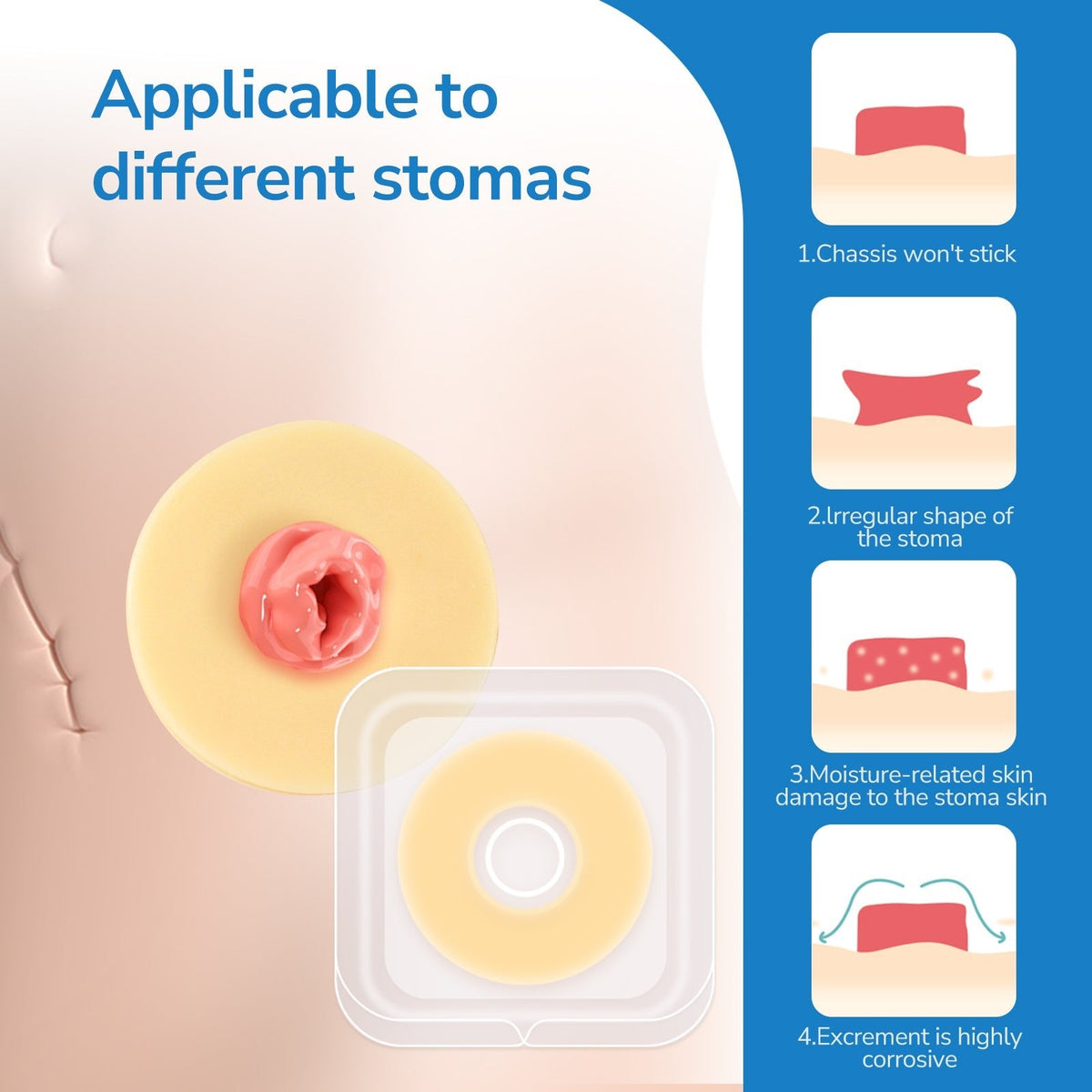 Onnohere 2mm Ostomy Barrier Rings – Hydrocolloid Moldable Seal for Leak Protection & Skin Comfort, Ostomy Care