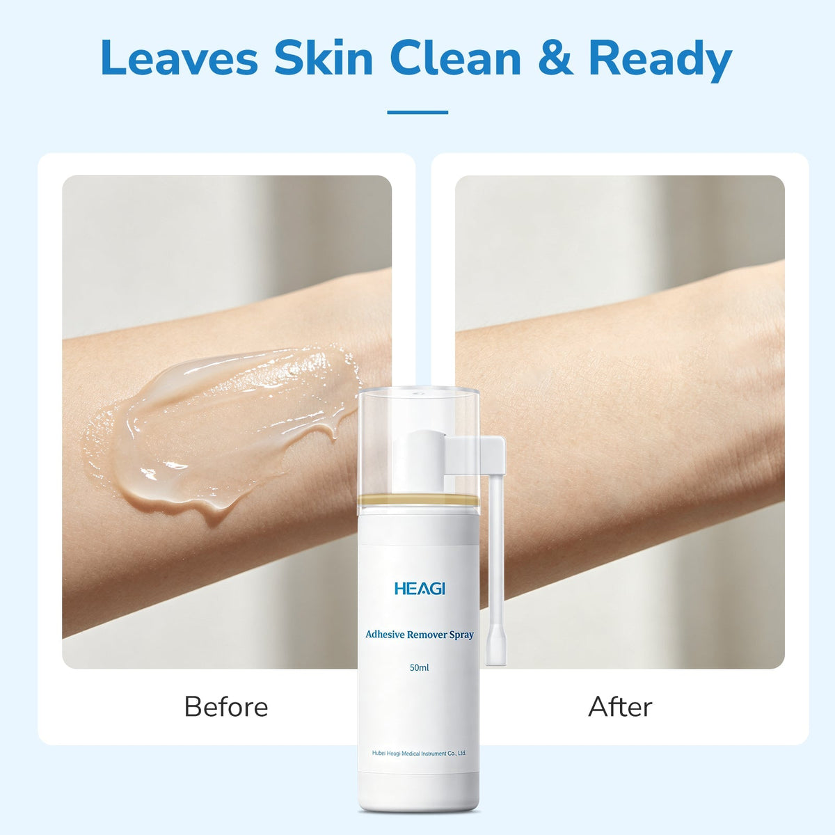 Onnohere Ostomy Adhesive Remover Spray – No-Sting Skin-Friendly Spray for Gentle Adhesive Removal (50ml) Ostomy Care