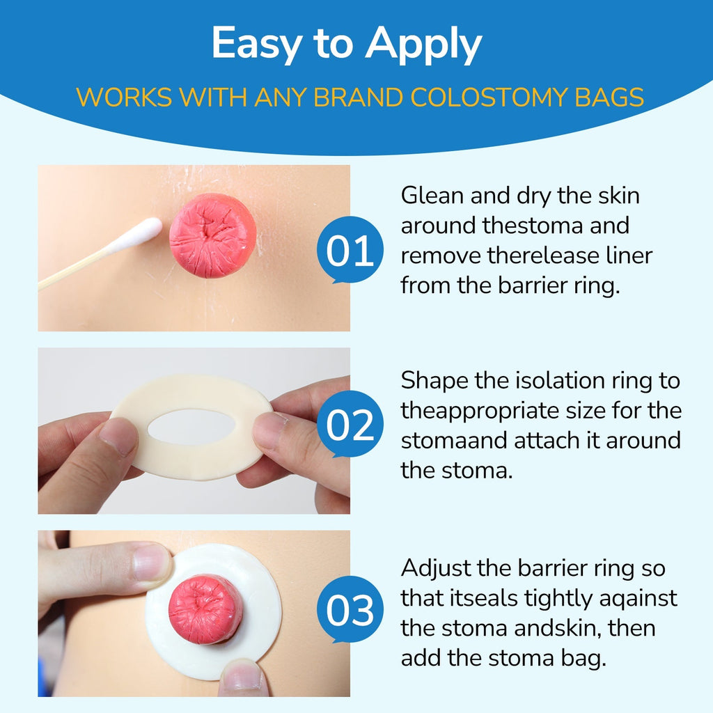 Onnohere Ostomy Barrier Rings Ostomy Supplies 2mm Thickness Moldable Ostomy Rings Medical Grade Hydrocolloid Adhesive