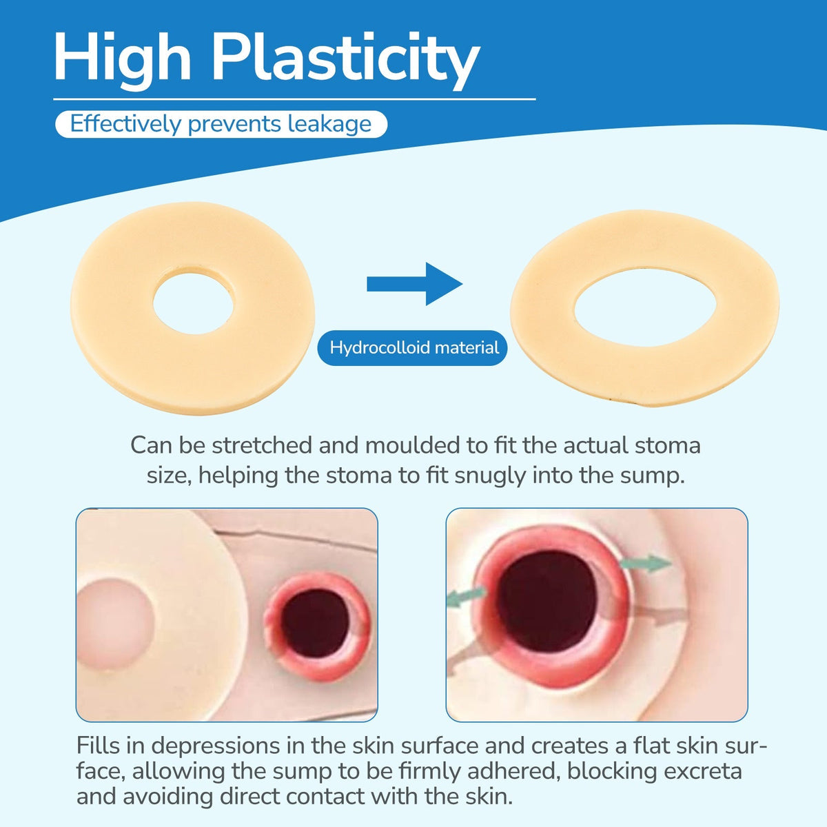 Onnohere Ostomy Barrier Rings Ostomy Supplies 2mm Thickness Moldable Ostomy Rings Medical Grade Hydrocolloid Adhesive
