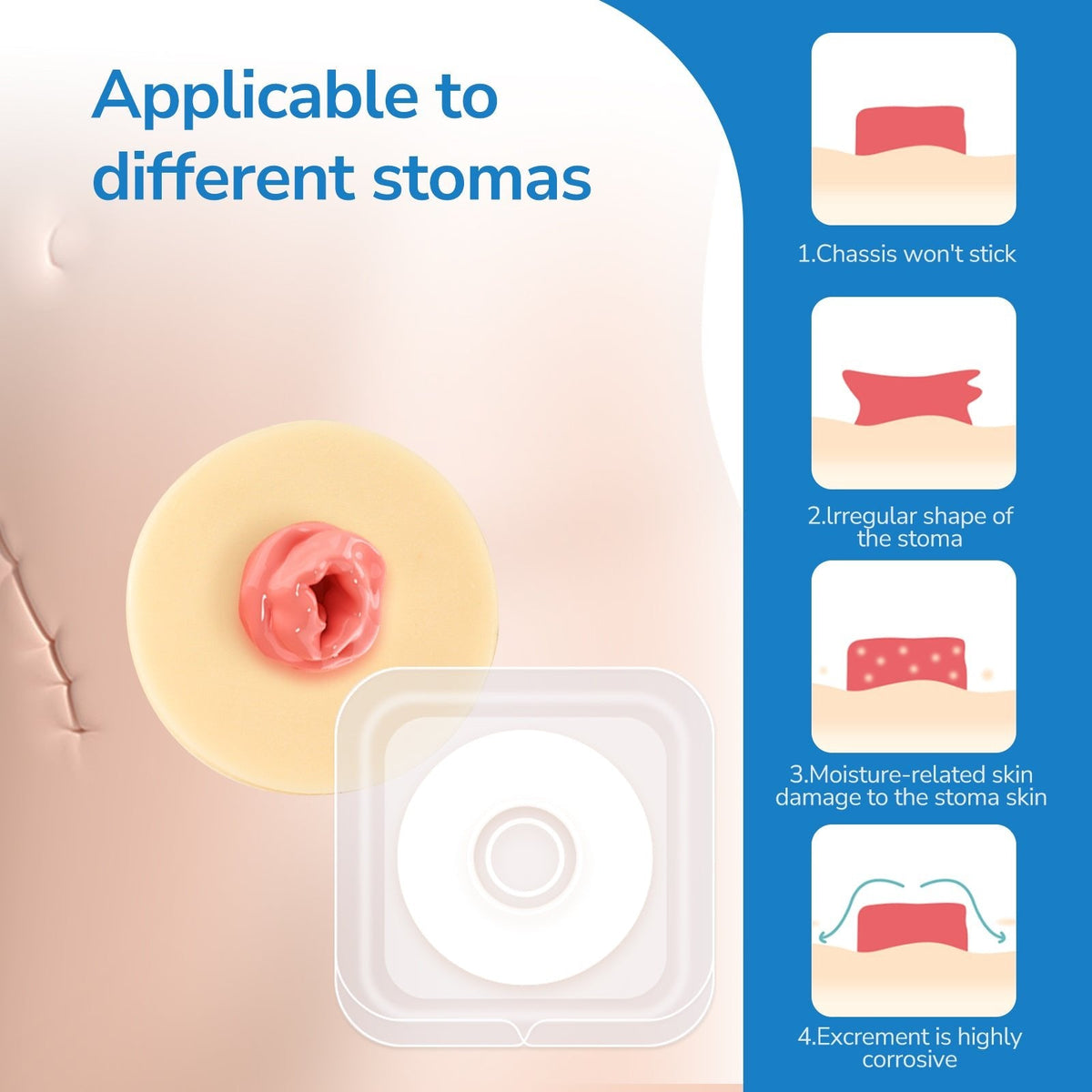 Onnohere Ostomy Barrier Rings Ostomy Supplies 2mm Thickness Moldable Ostomy Rings Medical Grade Hydrocolloid Adhesive